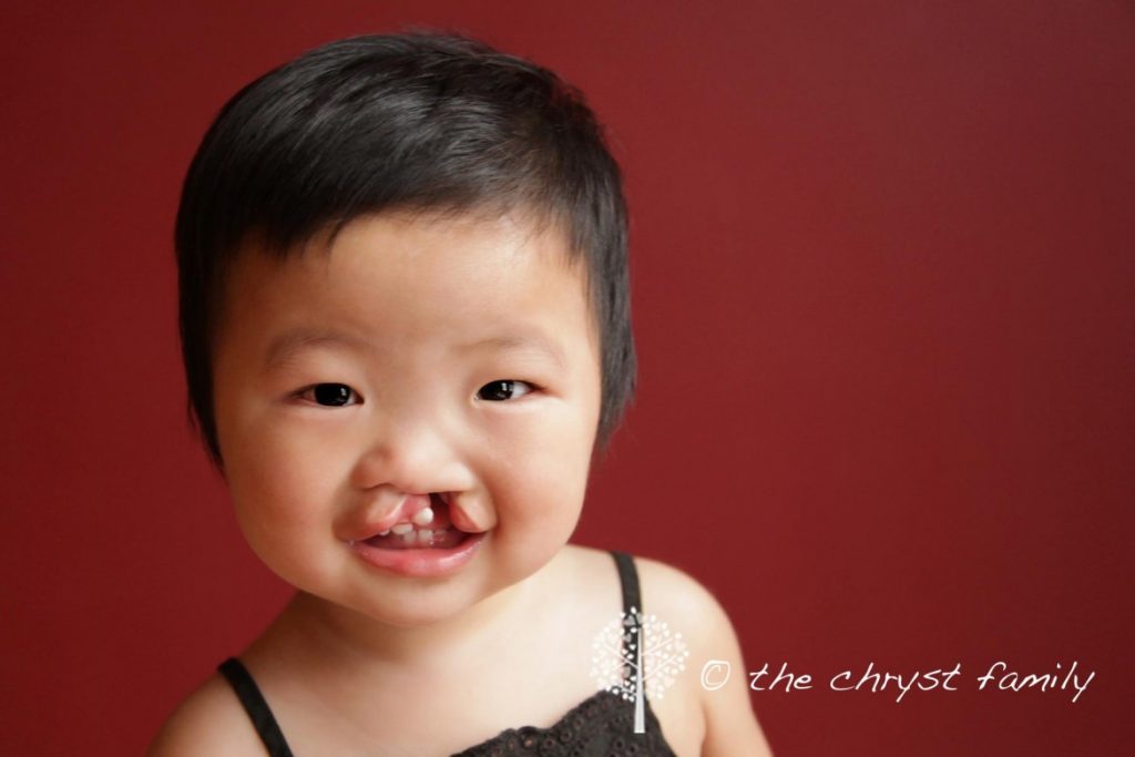 Plastic Surgery for Cleft palette abnormalities goes worldwide - WSQF ...