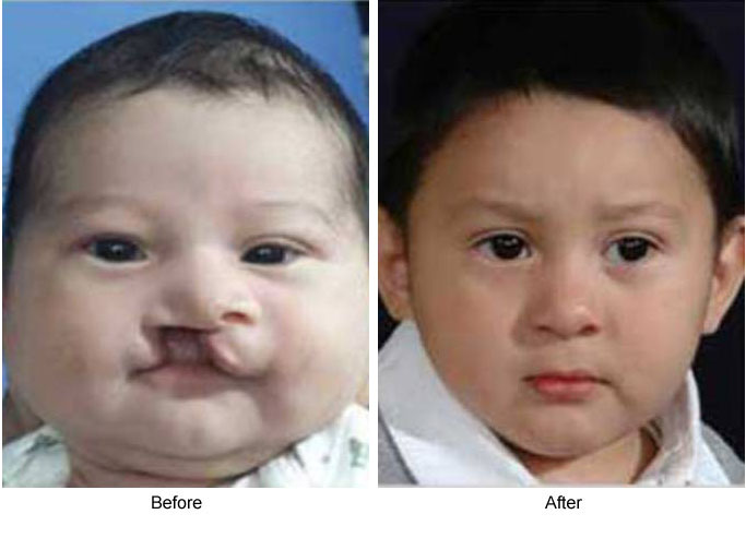 Plastic Surgery for Cleft palette abnormalities goes worldwide - WSQF ...